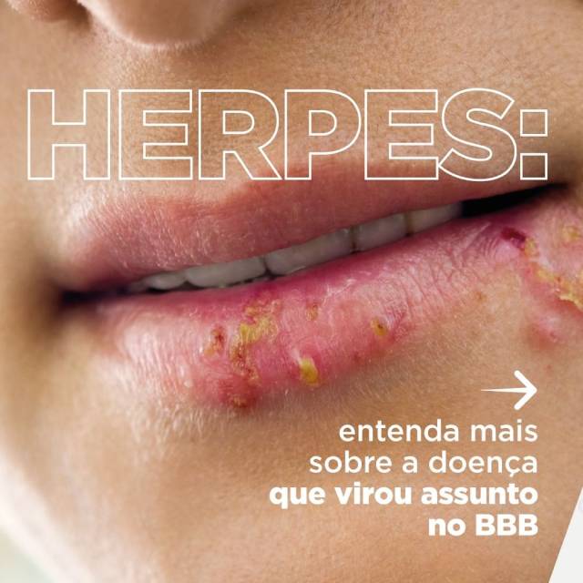 pic-news-herpes